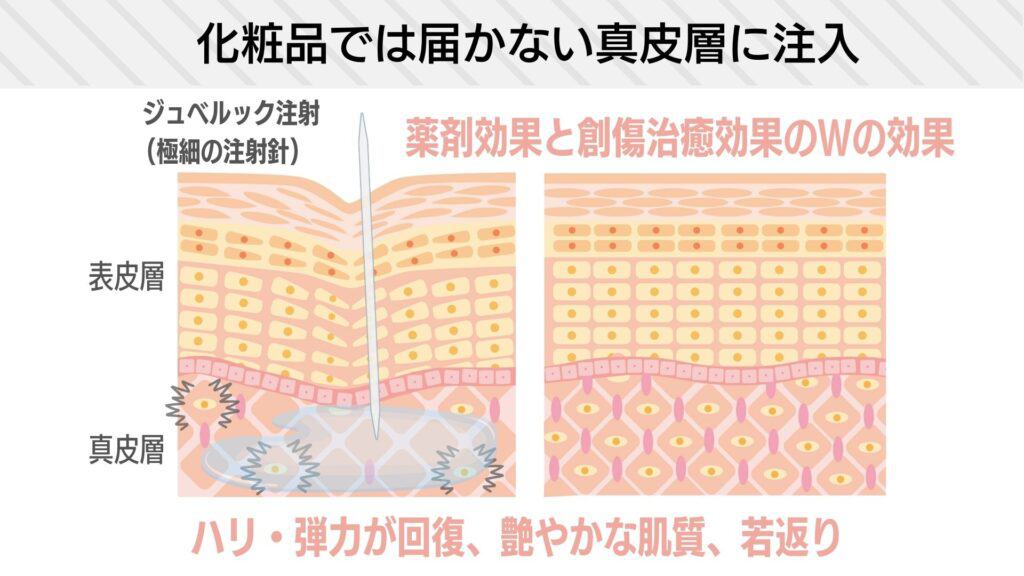 ジュべルック注射とは？(PDLLA)