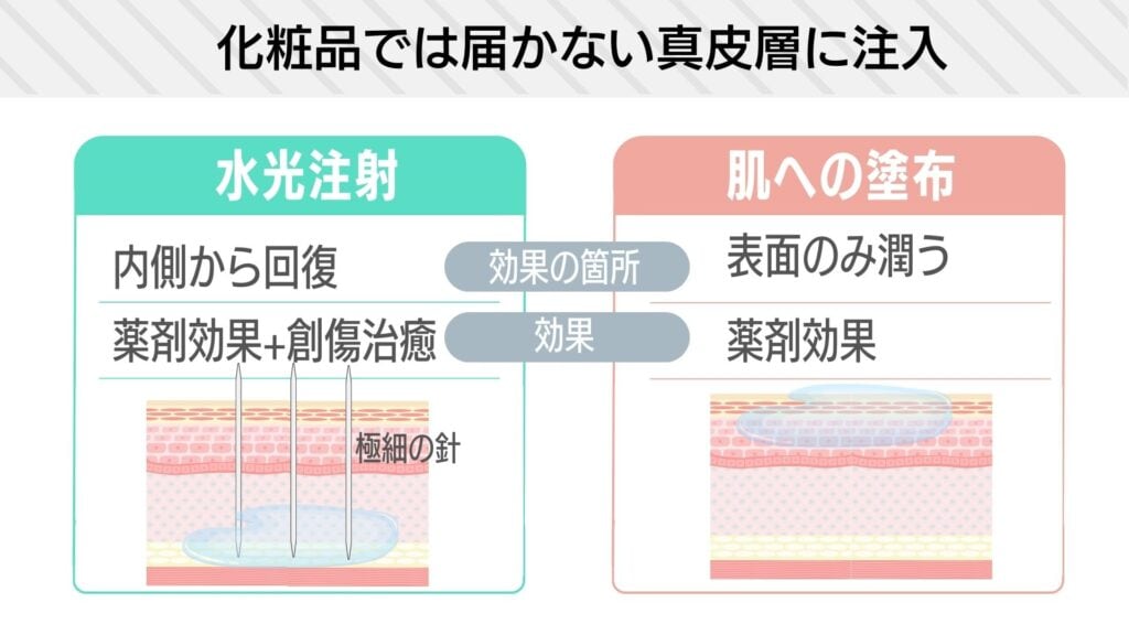 韓国発の水光注射