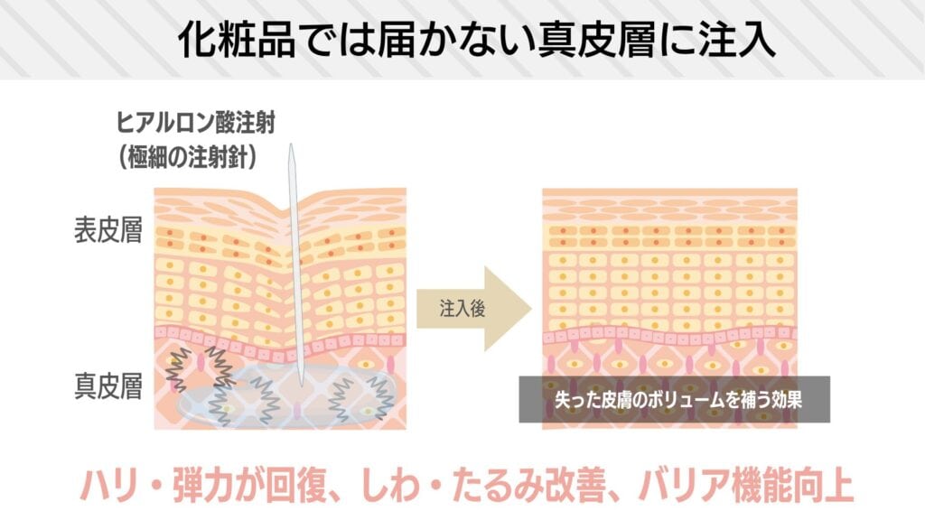 ヒアルロン酸の美容効果