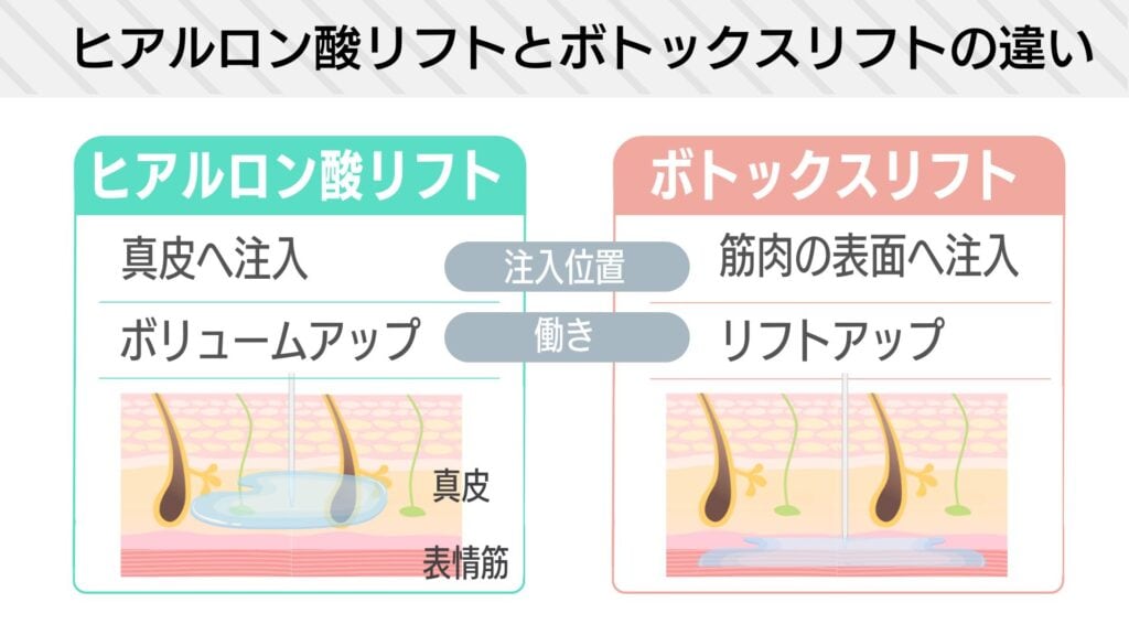 ヒアルロン酸リフトとボトックスリフトのちがい