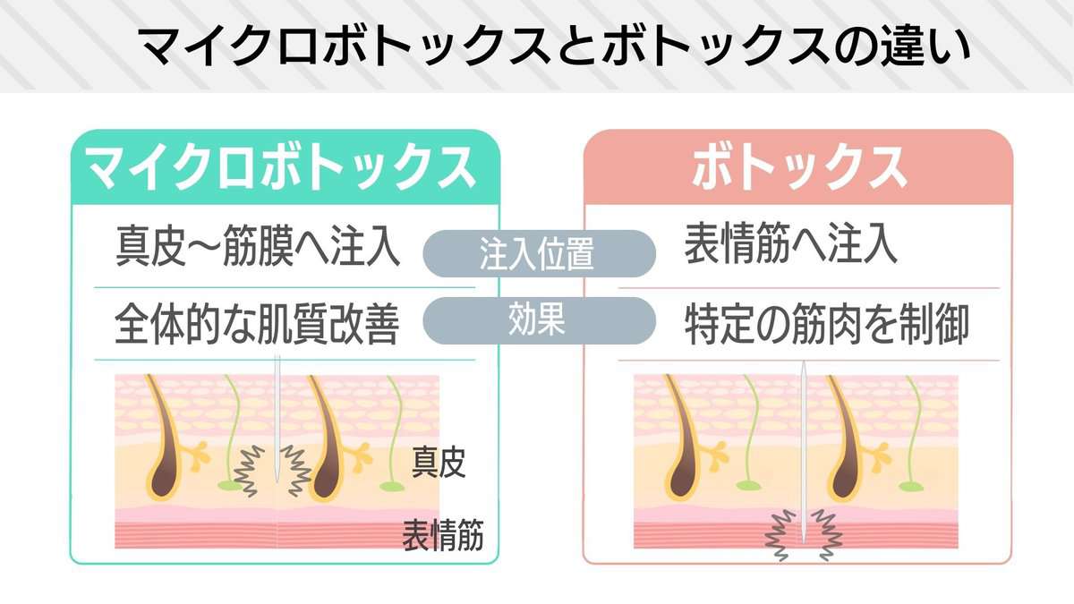 マイクロボトックスとボトックス注射のちがい