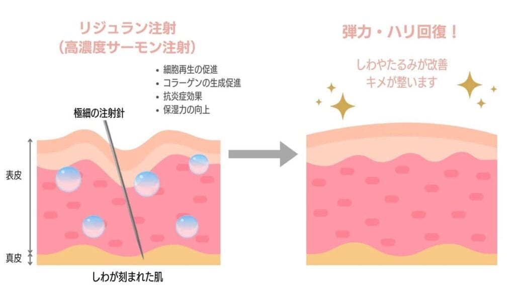 サーモン注射とリジュランの違いは5つ！どっちがいいか成分や効果を比較 | 渋谷肌育クリニック