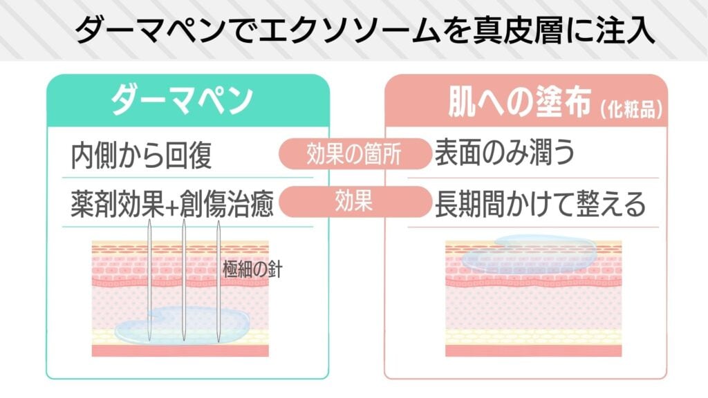 ダーマペン×エクソソームの効果とは